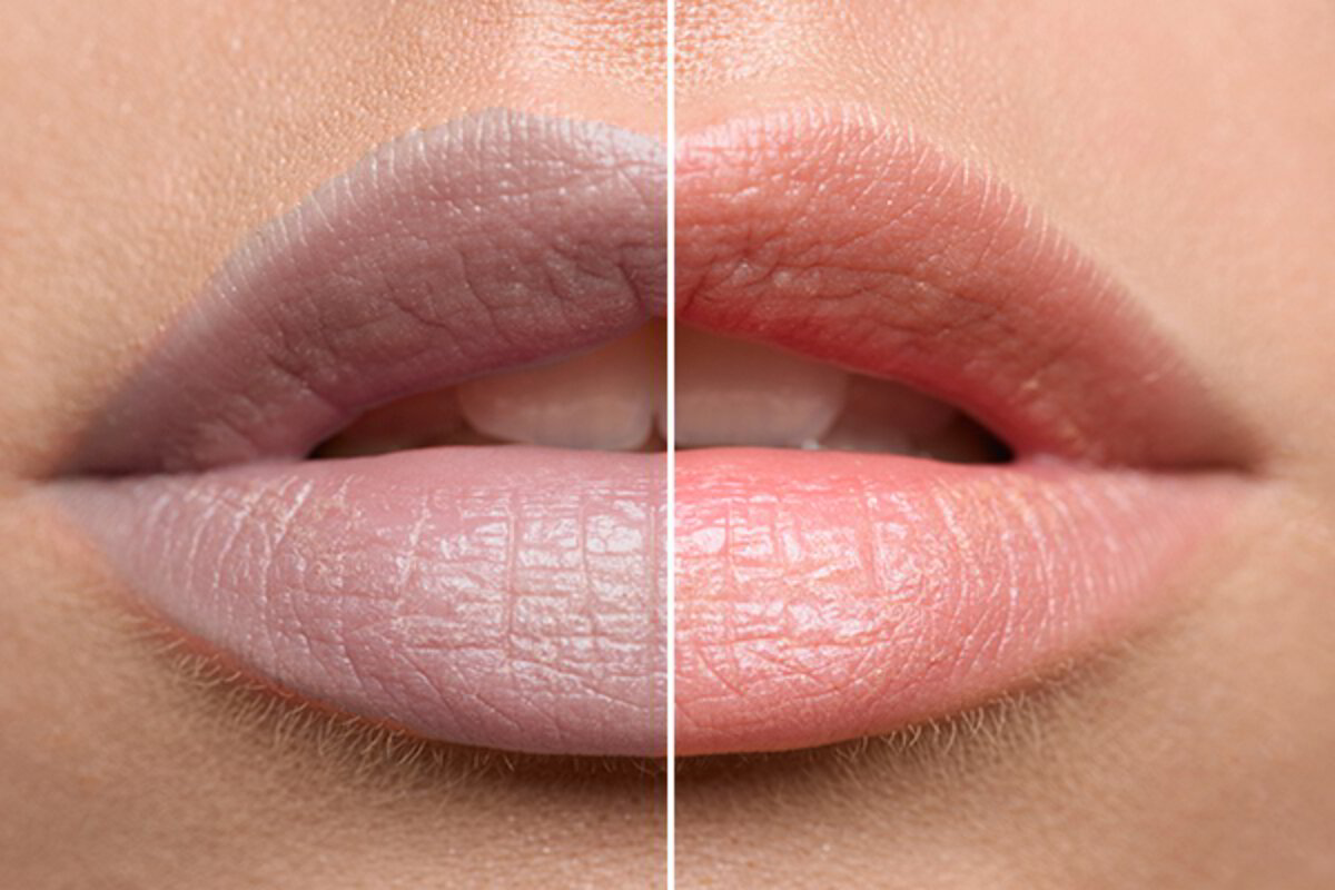 Lip Pigmentation Treatment